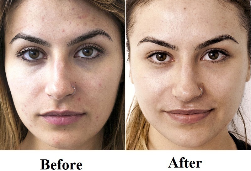 laser resurfacing